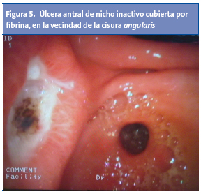 Figura 5. Úlcera antral de nicho inactivo cubierta por fibrina, en la vecindad de la cisura angularis