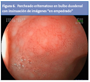 Figura 6. Parcheado eritematoso en bulbo duodenal con insinuación de imágenes “en empedrado”