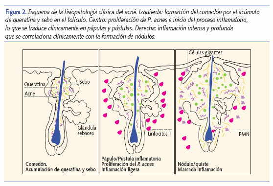 Esquema de la fisiopatología clásica del acné