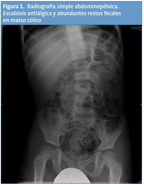 Figura 1. Radiografía simple abdominopélvica. Escoliosis antiálgica y abundantes restos fecales en marco cólico