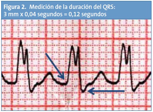 Figura 2. Medición de la duración del QRS: 3 mm x 0,04 segundos = 0,12 segundos