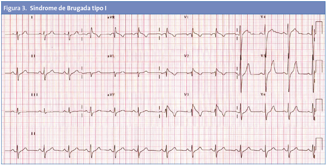 Figura 3. Síndrome de Brugada tipo I