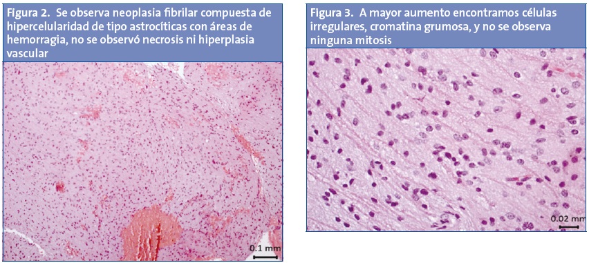 Figura 2. Se observa neoplasia fibrilar compuesta de hipercelularidad de tipo astrocíticas con áreas de hemorragia, no se observó necrosis ni hiperplasia vascular. Figura 3. A mayor aumento encontramos células irregulares, cromatina grumosa, y no se observa ninguna mitosis