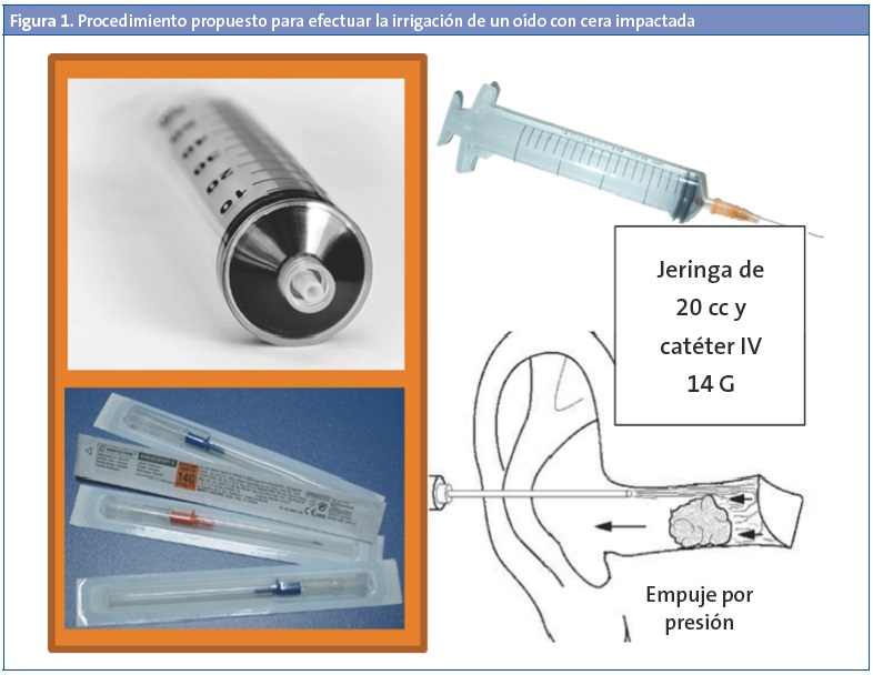 Figura 1. Procedimiento propuesto para efectuar la irrigación de un oído con cera impactada