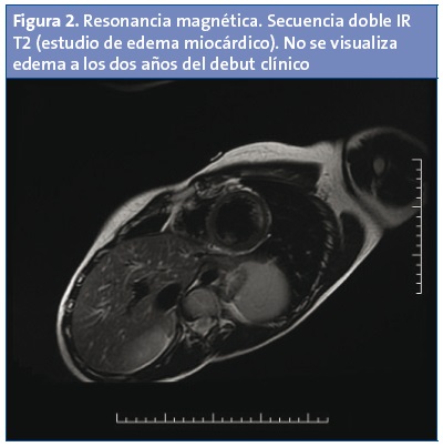 Figura 2. Resonancia magnética. Secuencia doble IR T2 (estudio de edema miocárdico). No se visualiza edema a los dos años del debut clínico.