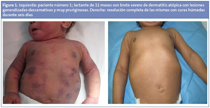 Figura 1. Izquierda: paciente número 1; lactante de 11 meses con brote severo de dermatitis atópica con lesiones generalizadas descamativas y muy pruriginosas. Derecha: resolución completa de las mismas con curas húmedas durante seis días.