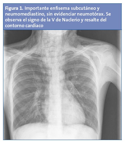 Figura 1. Importante enfisema subcutáneo y neumomediastino, sin evidenciar neumotórax. Se observa el signo de la V de Naclerio y resalte del contorno cardiaco