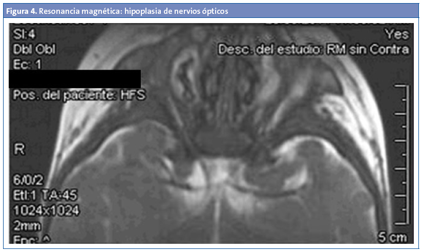 Figura 4. Resonancia magnética: hipoplasia de nervios ópticos