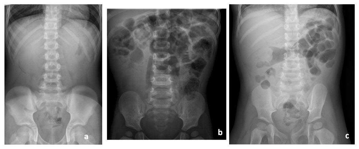 Figura 2. Radiografía de abdomen en pacientes con invaginación intestinal. a) Silencio abdominal; b) ausencia de aireación intestinal en flanco derecho; c) cabeza de invaginación intestinal a nivel de ángulo hepático