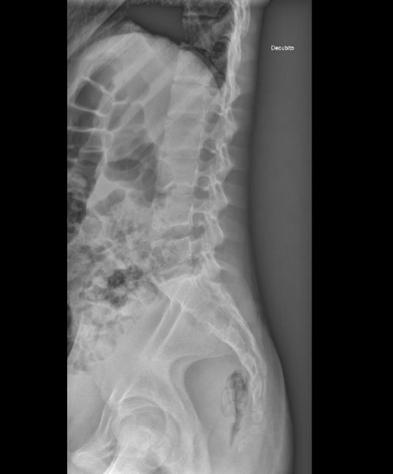 Figura 1. Radiografía lateral de columna lumbosacra: rectificación de la lordosis fisiológica lumbar