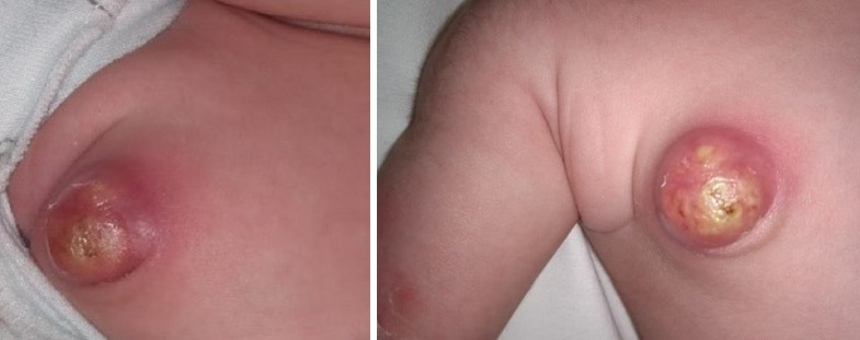 Figura 1. Evolución del absceso en mama derecha en lactante de 29 días, sin mejoría tras antibioterapia intravenosa. Empeoramiento tras ingreso