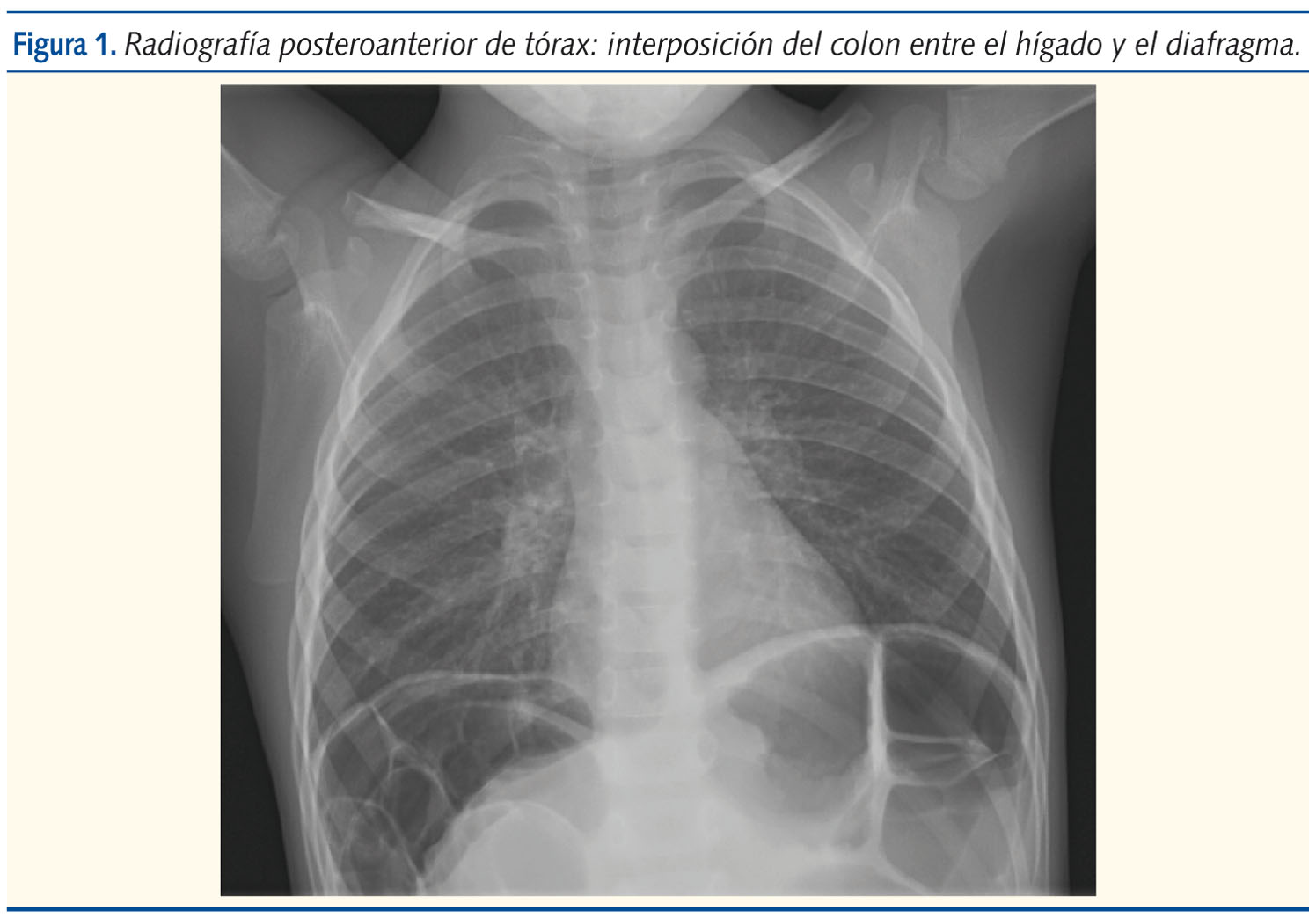 Figura 1. Radiografía posteroanterior de tórax: interposición del colon entre el hígado y el diafragma.