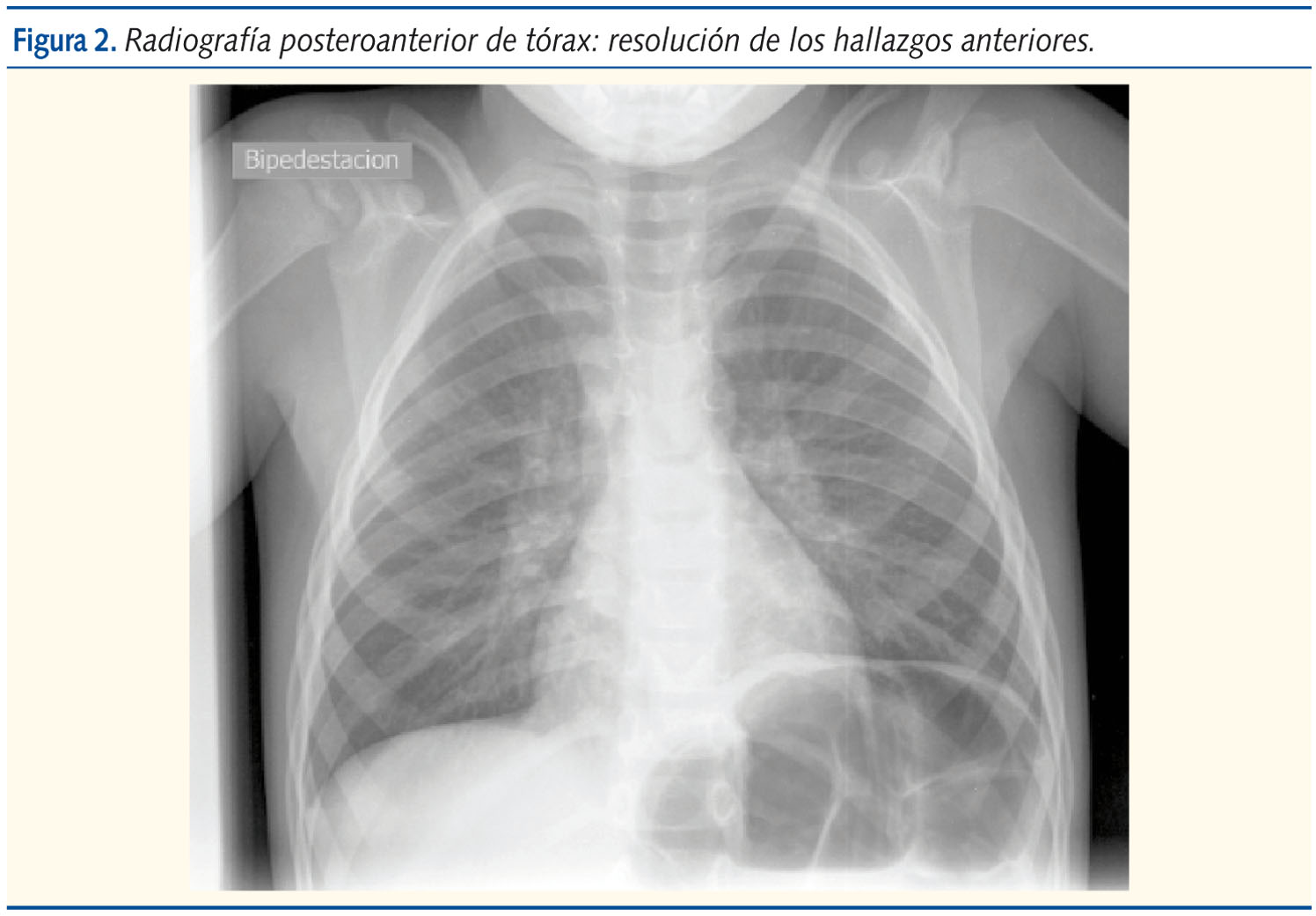 Figura 2. Radiografía posteroanterior de tórax: resolución de los hallazgos anteriores.