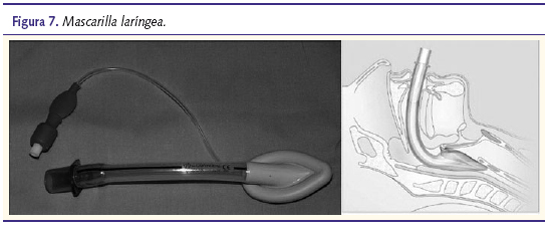 Figura 7. Mascarilla laríngea