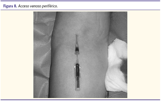 Figura 8. Acceso venoso periférico