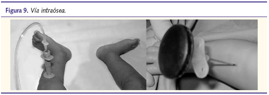 Figura 9. Vía intraósea