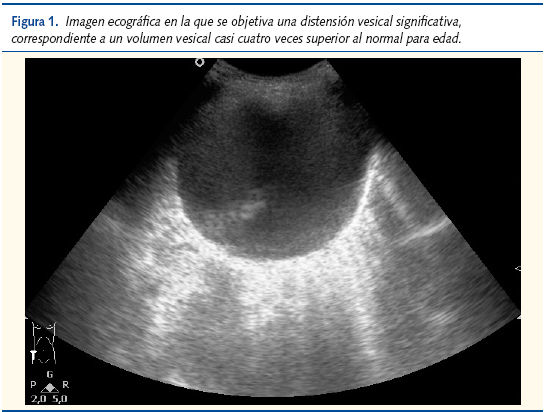 Figura 1. Imagen ecográfica en la que se objetiva una distensión vesical significativa, correspondiente a un volumen vesical casi cuatro veces superior al normal para edad.