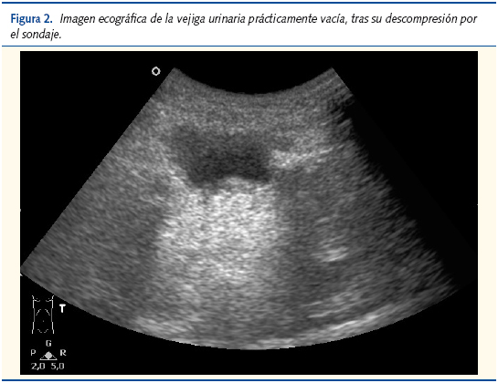 Figura 2. Imagen ecográfica de la vejiga urinaria prácticamente vacía, tras su descompresión por el sondaje.