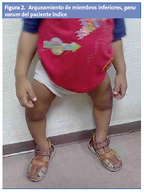 Figura 2. Arqueamiento de miembros inferiores, genu varum del paciente índice