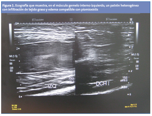 Figura 1. Ecografía que muestra, en el músculo gemelo interno izquierdo, un patrón heterogéneo con infiltración de tejido graso y edema compatible con piomiosistis