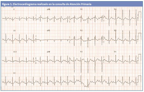 Figura 1. Electrocardiograma realizado en la consulta de Atención Primaria