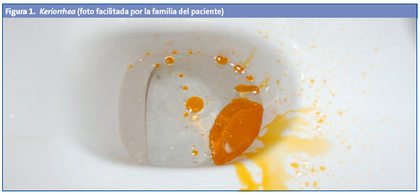 Figura 1. Keriorrhea (foto facilitada por la familia del paciente)