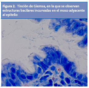 Figura 2. Tinción de Giemsa, en la que se observan estructuras bacilares incurvadas en el moco adyacente al epitelio