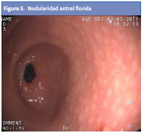 Figura 3. Nodularidad antral florida