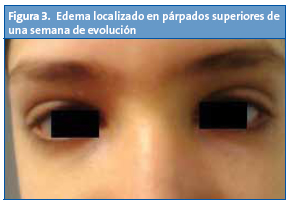 Figura 3. Edema localizado en párpados superiores de una semana de evolución