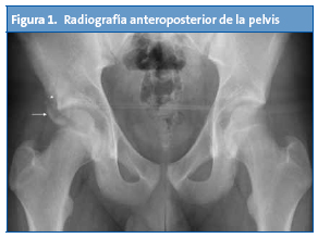 Figura 1. Radiografía anteroposterior de la pelvis