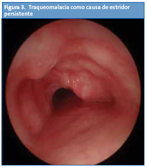 Figura 3. Traqueomalacia como causa de estridor persistente