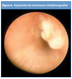 Figura 4. Aspiración de secreciones intrabronquiales