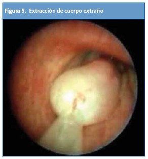Figura 5. Extracción de cuerpo extraño