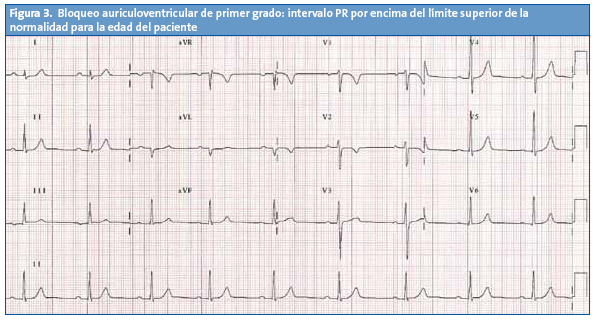Figura 3. Bloqueo auriculoventricular de primer grado: intervalo PR por encima del límite superior de la normalidad para la edad del paciente