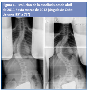 Figura 1. Evolución de la escoliosis desde abril de 2011 hasta marzo de 2012 (ángulo de Cobb de unos 35° a 77°)
