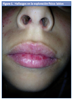 Figura 1. Hallazgos en la exploración física: labios.