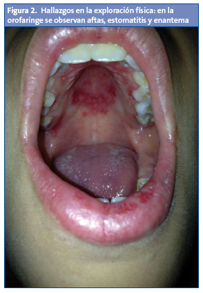Figura 2. Hallazgos en la exploración física: en la orofaringe se observan aftas, estomatitis y enantema.