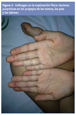 Figura 3. Hallazgos en la exploración física: lesiones purpúricas en los pulpejos de las manos, los pies y los talones.
