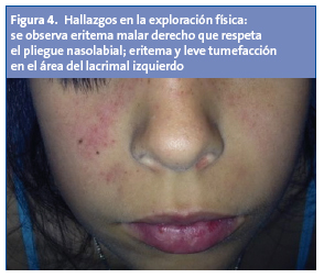 Figura 4. Hallazgos en la exploración física: se observa eritema malar derecho que respeta el pliegue nasolabial; eritema y leve tumefacción en el área del lacrimal izquierdo.