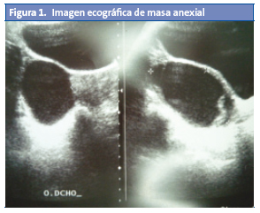 Figura 1. Imagen ecográfica de masa anexial