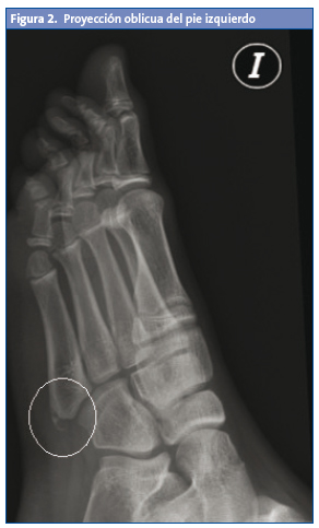 Figura 2. Proyección oblicua del pie izquierdo