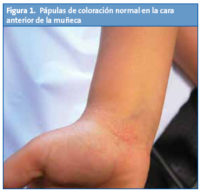 Figura 1. Pápulas de coloración normal en la cara anterior de la muñeca