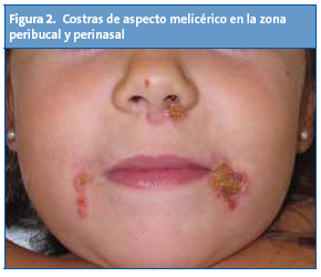 Figura 2. Costras de aspecto melicérico en la zona peribucal y perinasal