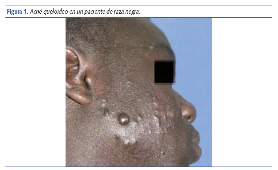 Acné queloideo en un paciente de raza negra