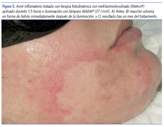 Acné inflamatorio con terapia fotodinámica con metilaminolevulinato