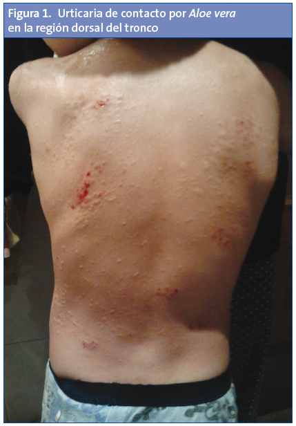 	Figura 1. Urticaria de contacto por Aloe vera en la región dorsal del tronco
