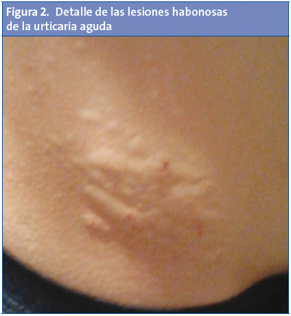 Figura 2. Detalle de las lesiones habonosas de la urticaria aguda