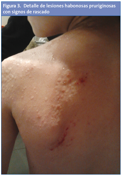 	Figura 3. Detalle de lesiones habonosas pruriginosas con signos de rascado