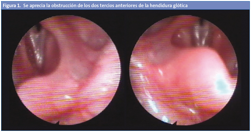 Figura 1. Se aprecia la obstrucción de los dos tercios anteriores de la hendidura glótica