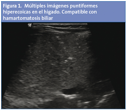 Figura 1. Múltiples imágenes puntiformes hiperecoicas en el hígado. Compatible con hamartomatosis biliar